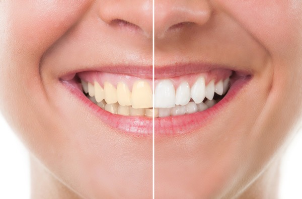 dentist tustin teeth whitening